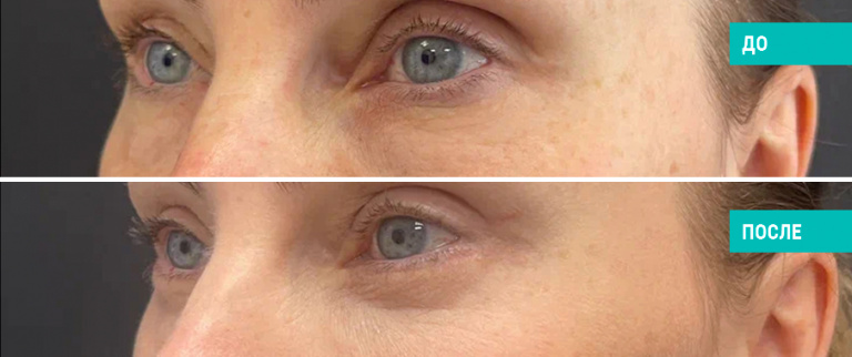 До и после круговой блефароплстики с кантопексией. Пластический хирург Л. Н. Гауэр