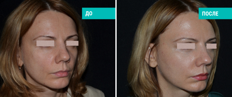 До и после липофилинга лица. Пластический хирург Гришкян Д. Р.