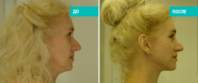 До и после липосакции подбородка. Пластический хирург Иванченкова Т. А.