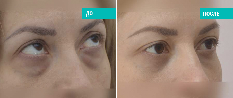 До и после трансконъюктивальной блефаропластики. Пластический хирург Маркушин А. А.