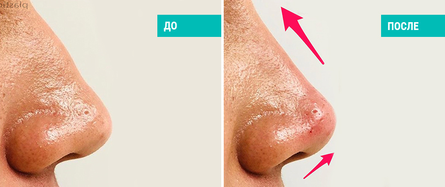 До и после коррекции носа филлерами. Косметолог Стамболцян Е. В.