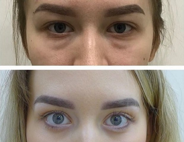 До и после блефаропластики. Пластический хирург А. А. Михайлов