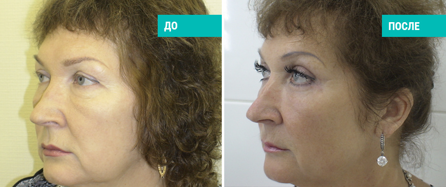 До и после круговой блефаропластики. Пластический хирург А. Е. Кашманов
