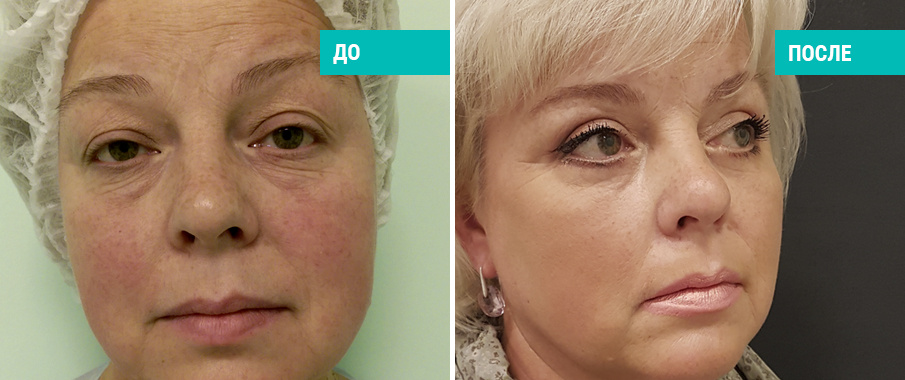 До и после круговой блефаропластики. Пластический хирург А. Е. Кашманов