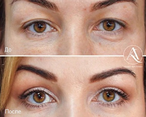 Пациентка А. Н. Ковынцева до и после пластики век
