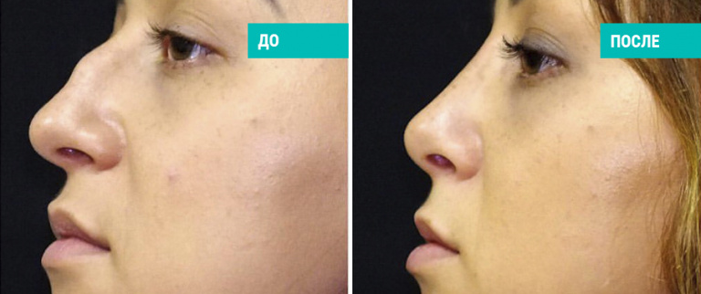 До и после ринопластики. Пластический хирург Г. П. Бабаян