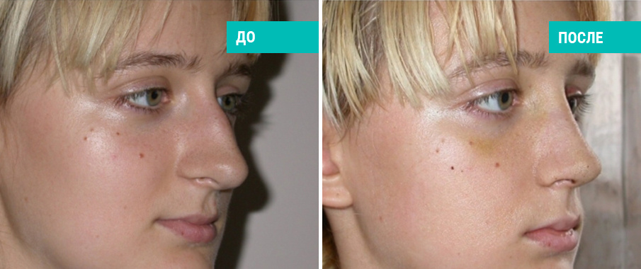 До и после ринопластики. Пластический хирург А. Н. Михайлов