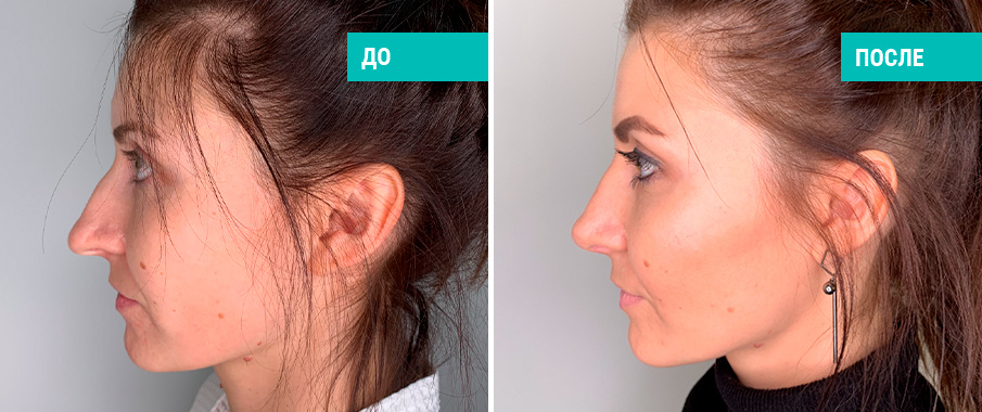 До и после ринопластики. Пластический хирург П. В. Пиманчев