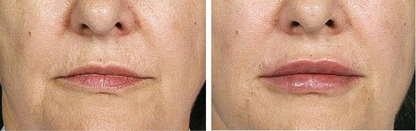 Фото до и после хейлопластики