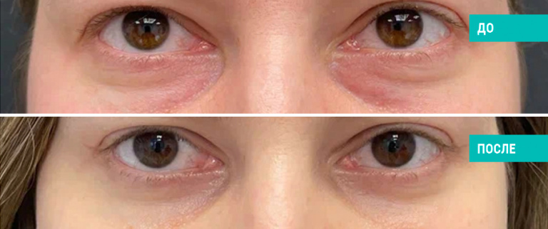 Блефаропластика. Пластический хирург Л. Н. Гауэр