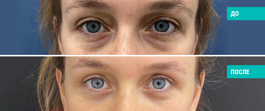 Блефаропластика. Пластический хирург Н. Б. Иоселиани