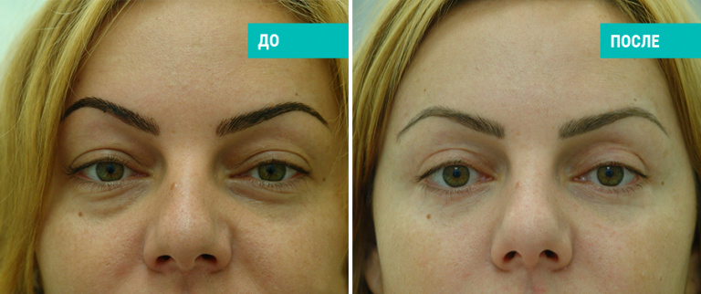 Блефаропластика. Пластический хирург В. Г. Якимец