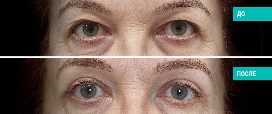 Блефаропластика. Пластический хирург В. В. Наумов