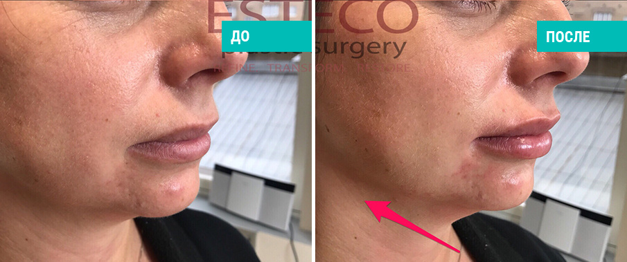 Ботулинотерапия + моделирование лица. Косметолог Е. В. Стамболцян