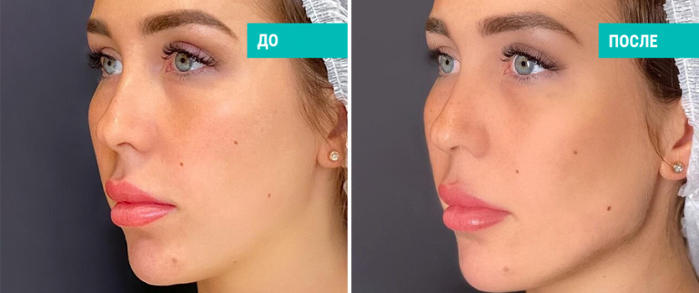 Контурная пластика филлерами. Косметолог С. А. Зубкова