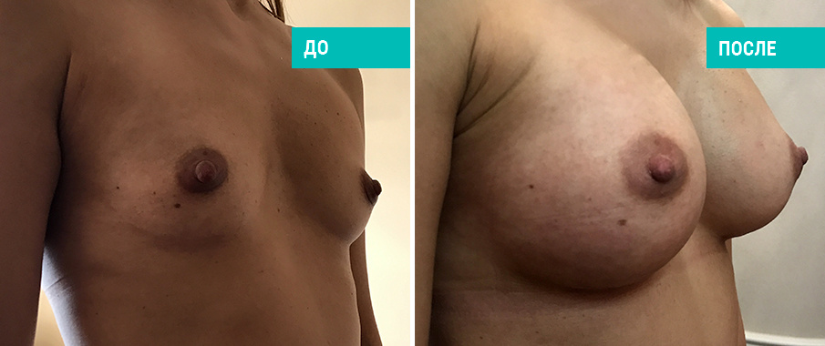До после маммопластики. Пациентка Д. В. Крысина