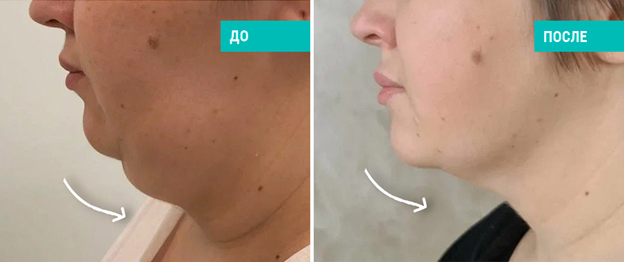 До и после липосакции подбородка. Пластический хирург Л. Н. Гауэр