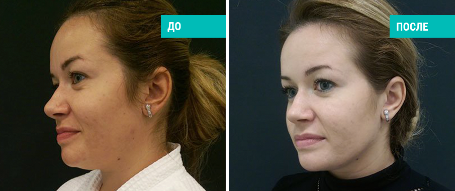 До и после Vaser-моделирования лица. Пластический хирург В. А. Зленко