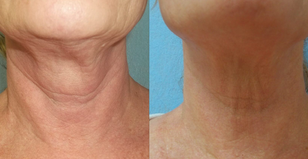 До и после инъекций филлеров в шею