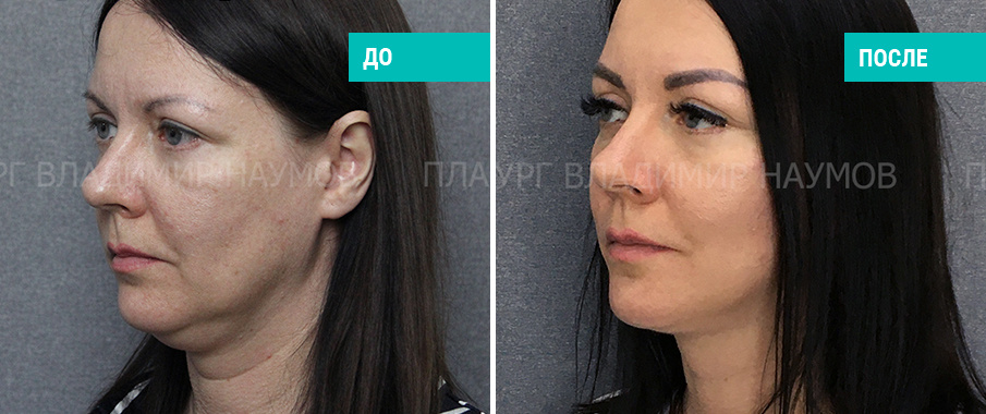 До и после комплексного омоложения лица и шеи. Пластический хирург В. В. Наумов