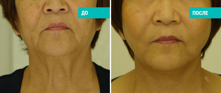 До и после хирургической коррекции лица и шеи. Пластический хирург В. Г. Якимец