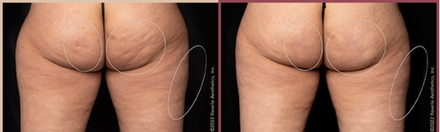 Фото до и после через 1 год. Источник фото: www.radianceavon.com