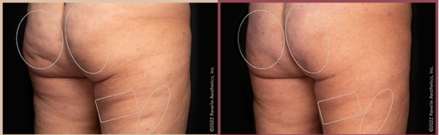 Фото до и после через 1 год. Источник фото: www.radianceavon.com