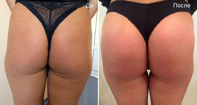 До и после липосакции и пластики ягодиц. Пластический хирург Д. В. Крысин