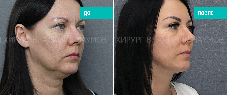 До и после подтяжки лица и шеи. Пластический хирург В. В. Наумов