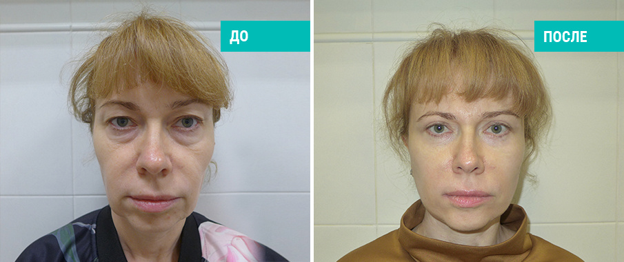 До и после пластики лица. Пластический хирург А. А. Михайлов