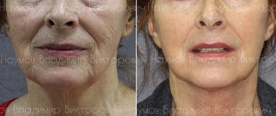 До и после омоложения лица. Пациентке 74 года. Пластический хирург В. В. Наумов