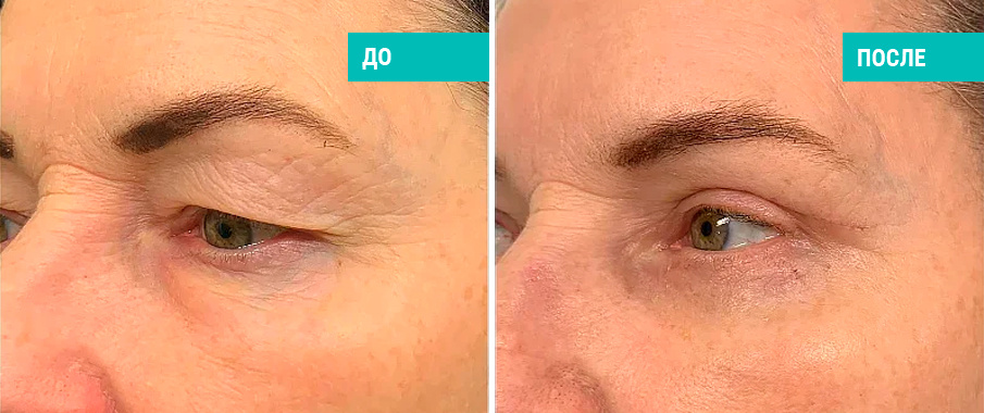 До и после блефаропластики. Пластический хирург Сафарян Д. Л.