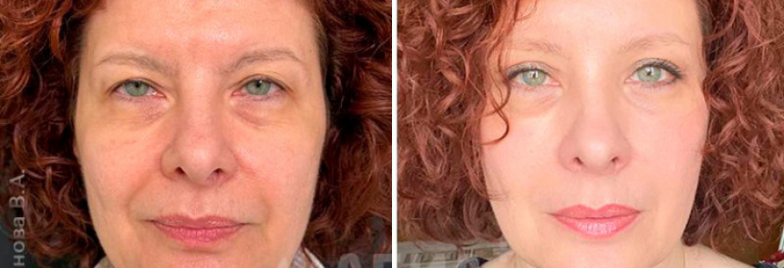 Эндоскопическая лобно-височная подтяжка