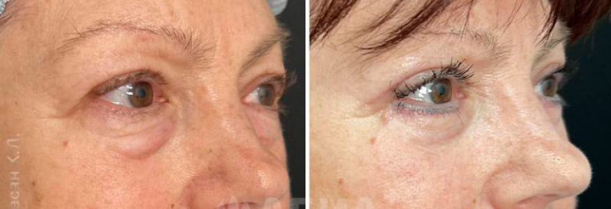 Блефаропластика