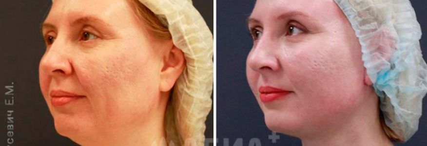 Подтяжка лица