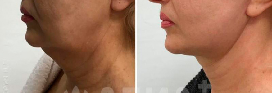 Подтяжка лица и шеи