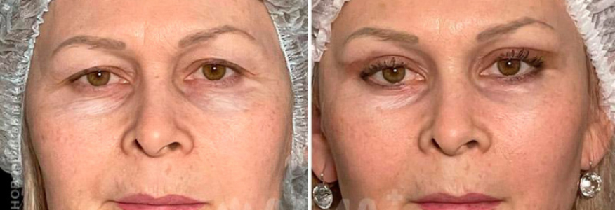 Эндоскопическая лобно-височная подтяжка и блефаропластика