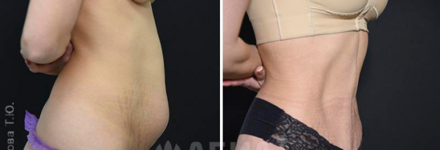 Абдоминопластика