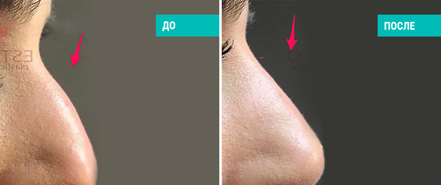 До и после контурной пластики филлерами. Косметолог Е. В. Стамболцян