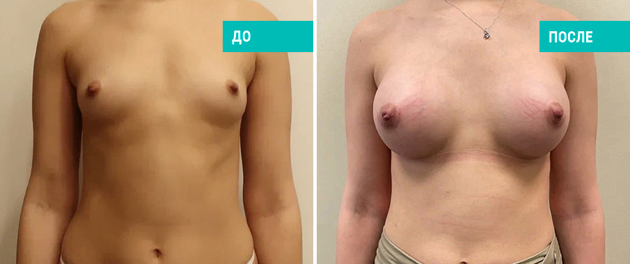 До и после увеличения груди. Пластический хирург Л. Н. Гауэр