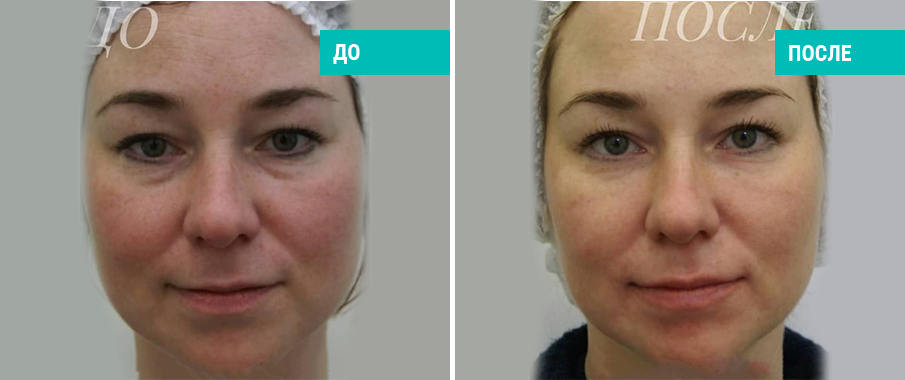 Контурная пластика филлерами. Косметолог М. А. Хавкин