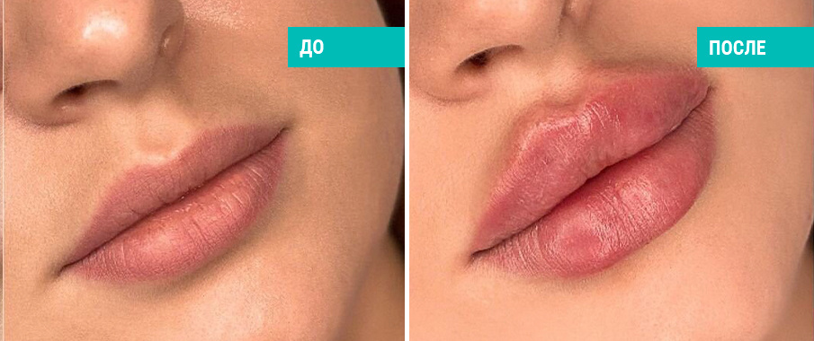 До и после увеличения губ филлерами. Косметолог С. А. Зубкова