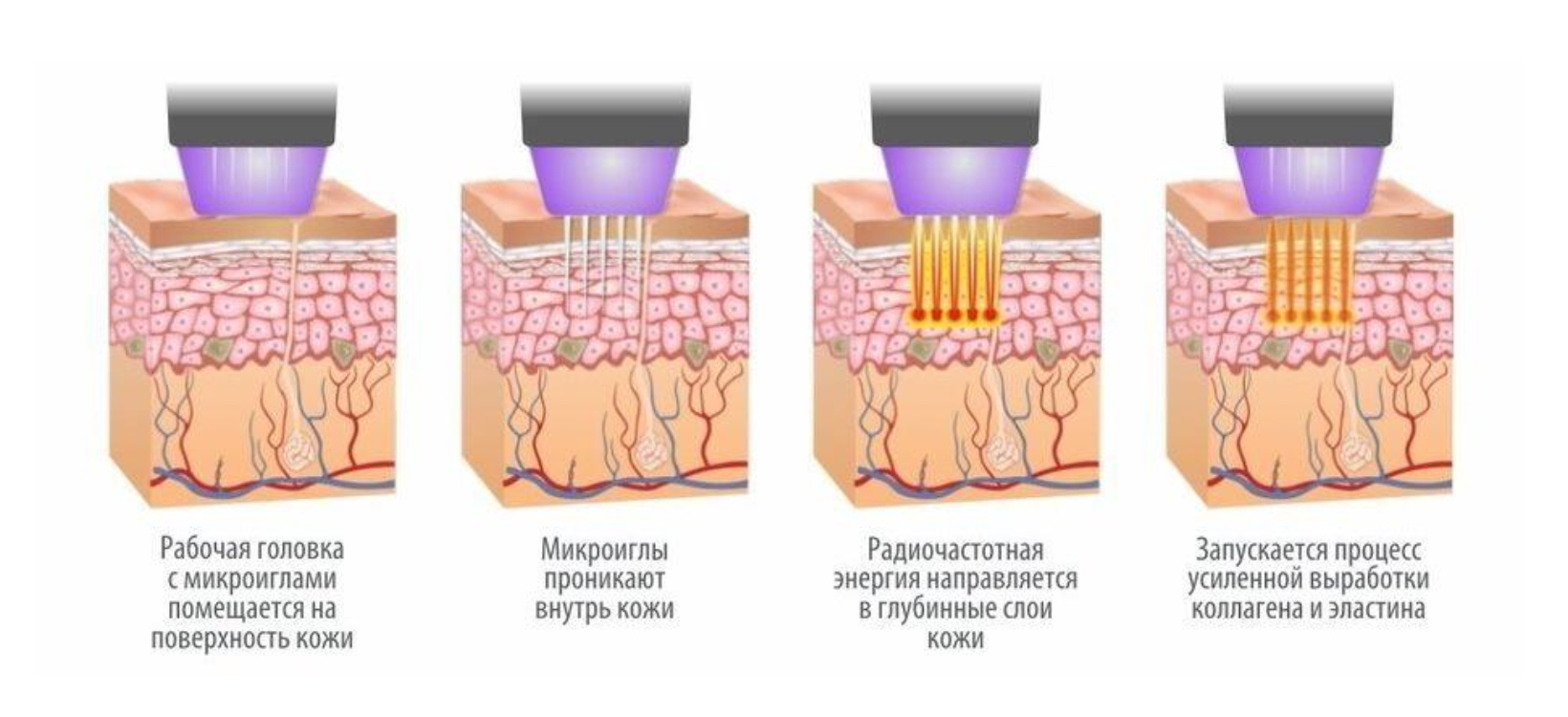 PRP микроиглы
