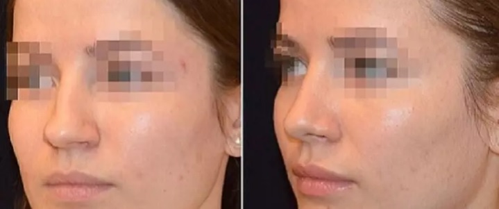 Фото до и через 25 дней после ринопластики. Пластический хирург Т. А. Алексанян