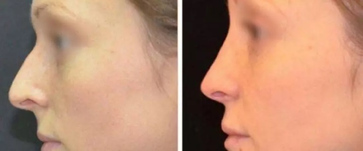 Фото до и через 14 дней после ринопластики. Пластический хирург Т. А. Алексанян