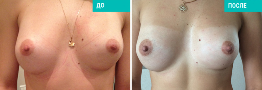 Маммопластика