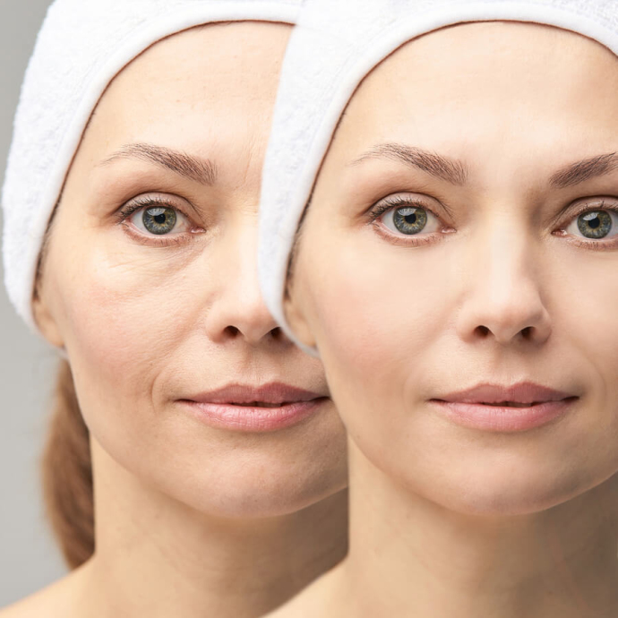 Подтяжка лица методом Deep Plane: молодость по-голливудски