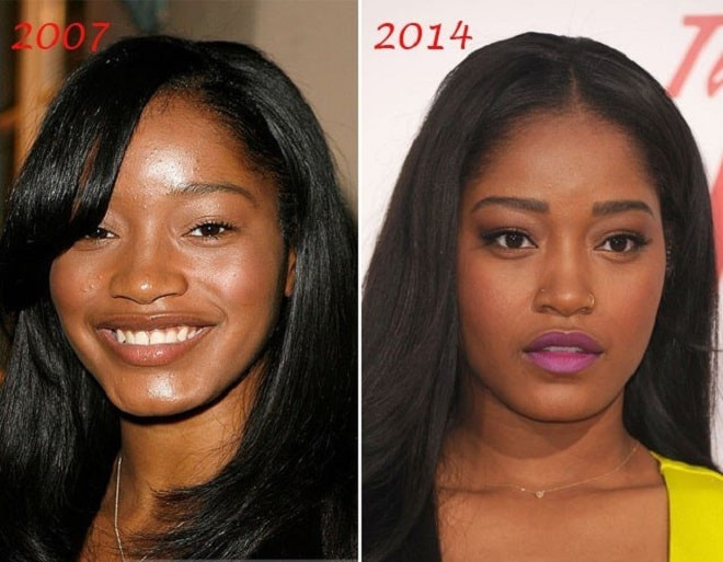 Фото: Кеке Палмер до и после пластики