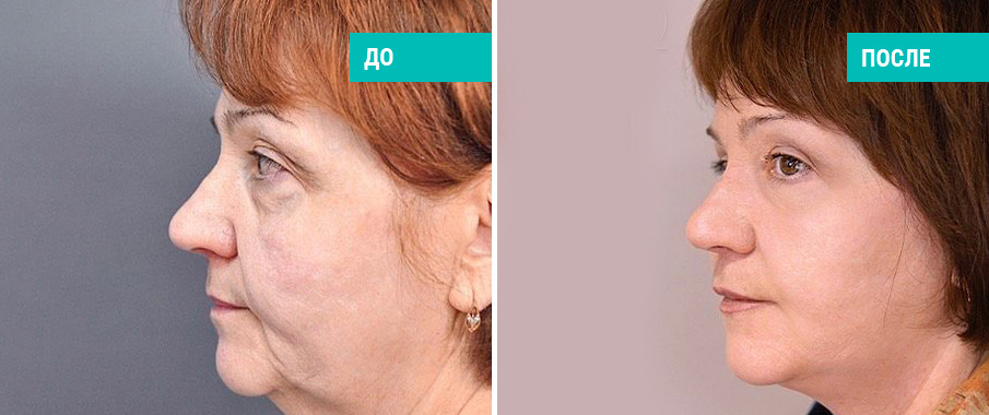 Подтяжка лица. Пластический хирург А. Н. Ковынцев