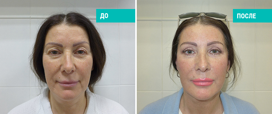 SMAS-подтяжка лица, подтяжка шеи и круговая блефаропластика. Пластический хирург А. А. Михайлов